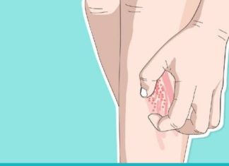 ბუნებრივი საშუალებები ფსორიაზის საწინააღმდეგოდ. სცადეთ ეს რეცეპტები