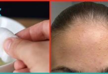 სცადეთ სახლის მარტივი საშუალებები, თუ შუბლზე გაქვთ გამონაყარი