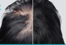 ნიღაბი თმის სწრაფი ზრდისთვის