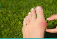 პოდაგრას მკურნალობა ხალხური მედიცინის რეცეპტებით