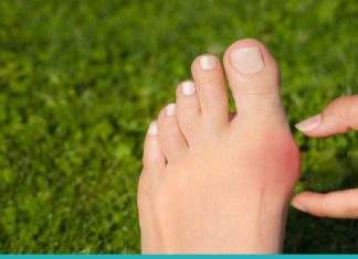 პოდაგრას მკურნალობა ხალხური მედიცინის რეცეპტებით