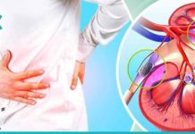 მოიშორეთ თირკმლიდან კენჭები მარტივი და ბუნებრივი გზით