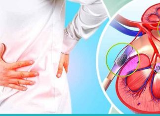 მოიშორეთ თირკმლიდან კენჭები მარტივი და ბუნებრივი გზით