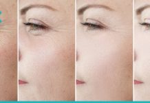 როგორ მოვიშოროთ მიმიკური ნაოჭები თვალებქვეშ?