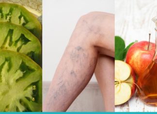 ვარიკოზის მკურნალობა სახლის პირობებში