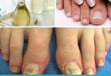 6 ეფექტური პროდუქტი ფრჩხილის სოკოსთან საბრძოლველად