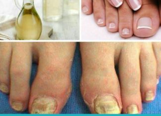 6 ეფექტური პროდუქტი ფრჩხილის სოკოსთან საბრძოლველად