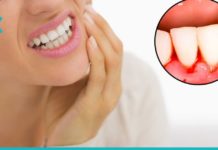 Ბუნებრივი საშუალებები ღრძილებიდან სისხლდენის დროს