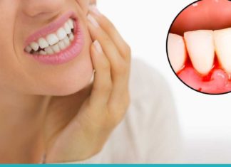 Ბუნებრივი საშუალებები ღრძილებიდან სისხლდენის დროს