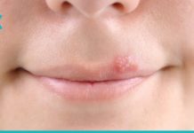 ჰერპესის მოშორების ტრადიციული მეთოდები