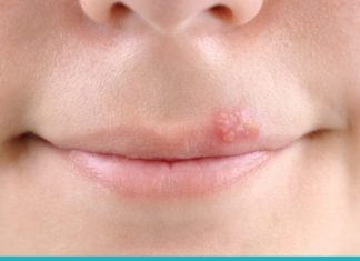 ჰერპესის მოშორების ტრადიციული მეთოდები