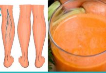 ბებიების რეცეფტი ვარიკოზული ვენების სამკურნალოდ.