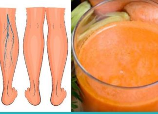 ბებიების რეცეფტი ვარიკოზული ვენების სამკურნალოდ.