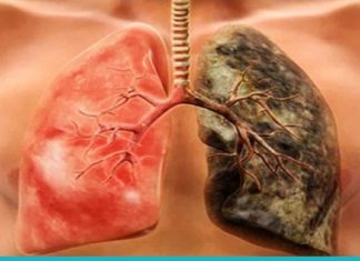 8 პროდუქტი, რომელიც კლავს ნიკოტინს