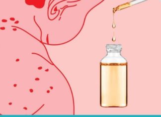 10 საუკეთესო ხალხური საშუალება ჩუტყვავილას სამკურნალოდ