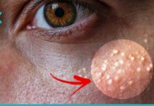 როგორ მოვიშოროთ მილიები, იგივე თეთრი წერტილები სახლის პირობებში