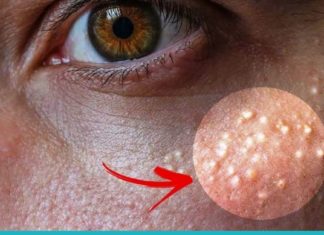 როგორ მოვიშოროთ მილიები, იგივე თეთრი წერტილები სახლის პირობებში