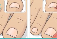 ჩაზრდილის ფრჩხილის მკურნალობა სახლის პირობებში. ძალიან მარტივია