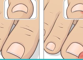 ჩაზრდილის ფრჩხილის მკურნალობა სახლის პირობებში. ძალიან მარტივია