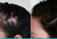 3 ბუნებრივი საშუალება თმის ცვენის თავიდან ასაცილებლად