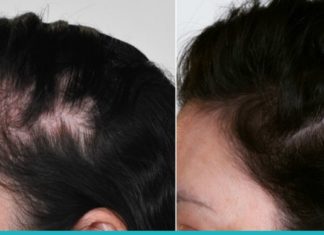 3 ბუნებრივი საშუალება თმის ცვენის თავიდან ასაცილებლად