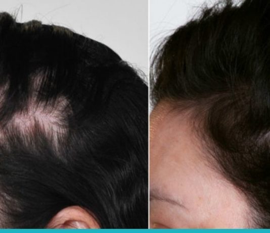 3 ბუნებრივი საშუალება თმის ცვენის თავიდან ასაცილებლად