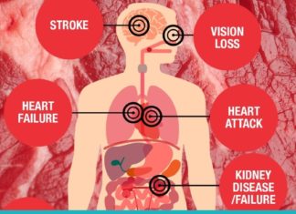 მაღალი წნევა და გულის პრობლემები გაწუხებთ? მაშინ სასწრაფოდ უარი თქვით ამ პროდუქტებზე