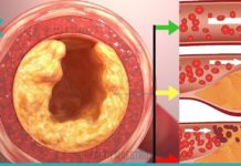 სასმელი, რომელიც გამოიყენება სისხლში ქოლესტერინის დონის შესამცირებლად და ცხიმის დასაწვავად!