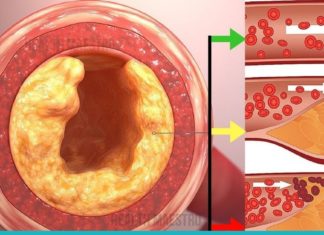 სასმელი, რომელიც გამოიყენება სისხლში ქოლესტერინის დონის შესამცირებლად და ცხიმის დასაწვავად!