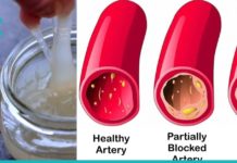 სუფთა სისხლძარღვები: 5 ოქროს რეცეპტი ექიმბაშებისგან