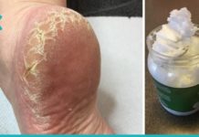 როგორ გავუმკლავდეთ დაბზარულ ქუსლებს?