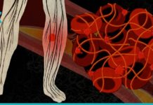 თრომბოზის მკურნალობა ხალხური საშუალებებით