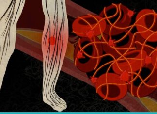 თრომბოზის მკურნალობა ხალხური საშუალებებით