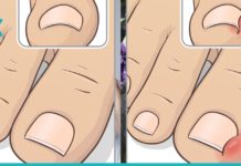 როგორ უნდა უმკურნალოთ ჩაბრუნებულ ფრჩხილს? სასარგებლო და ეფექტური რჩევები