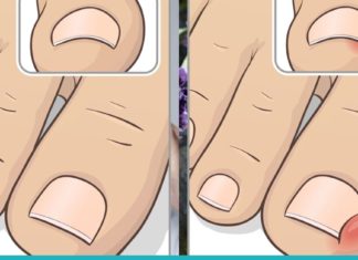 როგორ უნდა უმკურნალოთ ჩაბრუნებულ ფრჩხილს? სასარგებლო და ეფექტური რჩევები