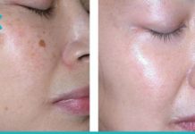 პიგმენტური ლაქების და ნაოჭების საწინაღმდეგო საუკეთესო მეთოდი!