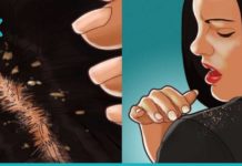 ქერტლის მოშორებას ამ 1 ინგრედიენტით შეძლებთ. საოცრად ეფექტურია