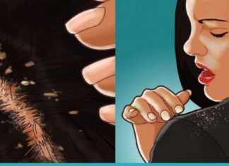 ქერტლის მოშორებას ამ 1 ინგრედიენტით შეძლებთ. საოცრად ეფექტურია