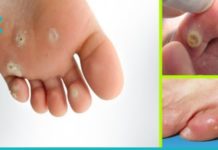 მოიშორეთ მაზოლები ამ ხალხური საშუალებებით და დაემშვიდობეთ მათ სამუდამოდ