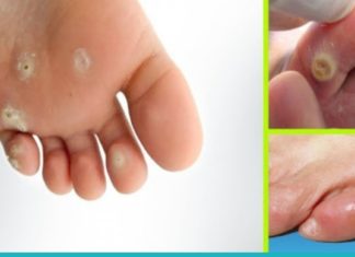 მოიშორეთ მაზოლები ამ ხალხური საშუალებებით და დაემშვიდობეთ მათ სამუდამოდ