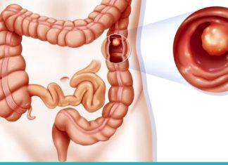 ჩაი ნაწლავის პოლიპების სამკურნალოდ