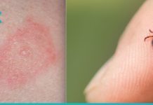 რჩევები- რა უნდა გააკეთოთ, თუ ტკიპამ გიკბინათ?