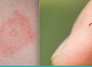 რჩევები- რა უნდა გააკეთოთ, თუ ტკიპამ გიკბინათ?