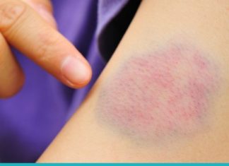 მარილიანი წყალი დაჟეჟილობის დროს