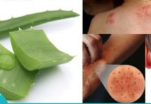 ალოე ვერა დერმატიტის, ფსორიოზის და ეგზემის სამკურნალოდ