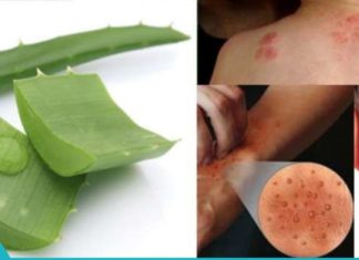 ალოე ვერა დერმატიტის, ფსორიოზის და ეგზემის სამკურნალოდ