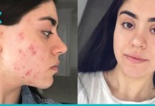 5 პროდუქტი, რომელიც არეგულირებს ჰორმონებს და კანის მდგომარეობას.