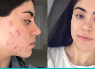 5 პროდუქტი, რომელიც არეგულირებს ჰორმონებს და კანის მდგომარეობას.