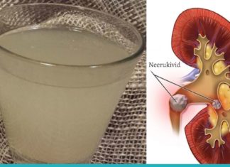 როგორ დავშალოთ თირკმელებში კენჭები? თქვენ ეს უნდა იცოდეთ!