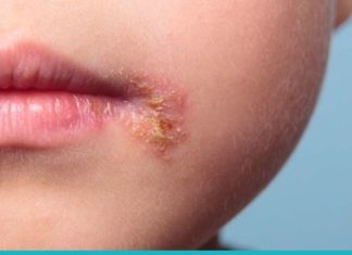ჰერპესის მკურნალობა უმოკლეს დროში, მარტივად და იაფად